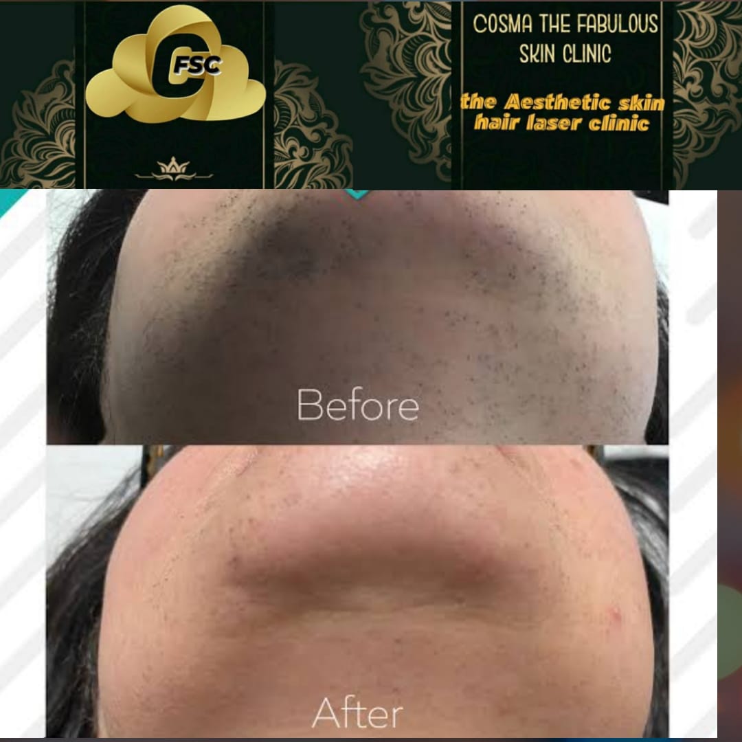 Before After Hair Treatment